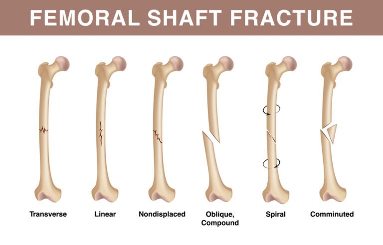 Femoral Shaft Fractures Types Causes And Treatment Zealmax