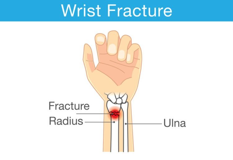 Wrist Fractures Types Symptoms Causes Treatment Zealmax