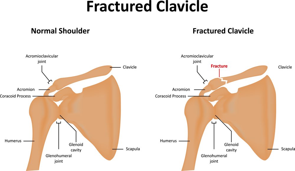 symptoms of calvical fracture