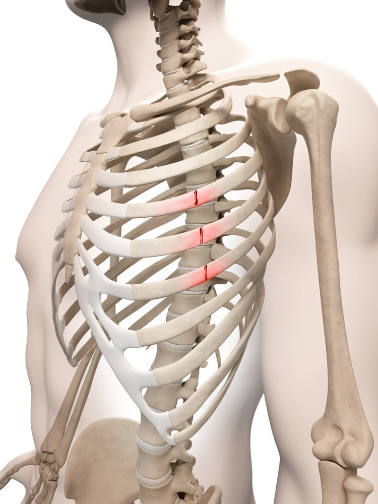 Treatment Of Rib Fracture Symptoms Recovery Time And Surgical