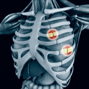 types of rib fracture