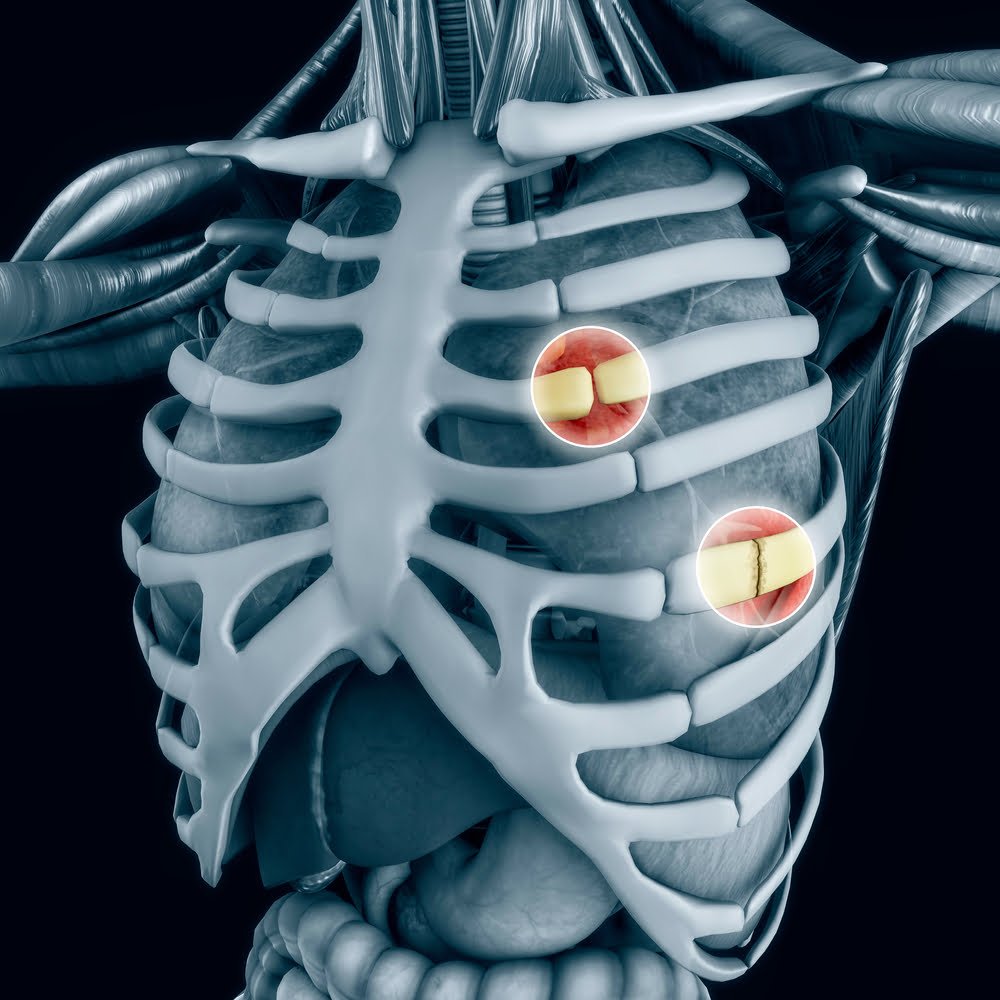 Broken Rib Causes Signs Symptoms Recovery Time Treatm vrogue.co