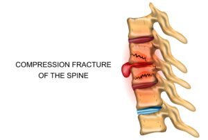 compression fracture of the spine