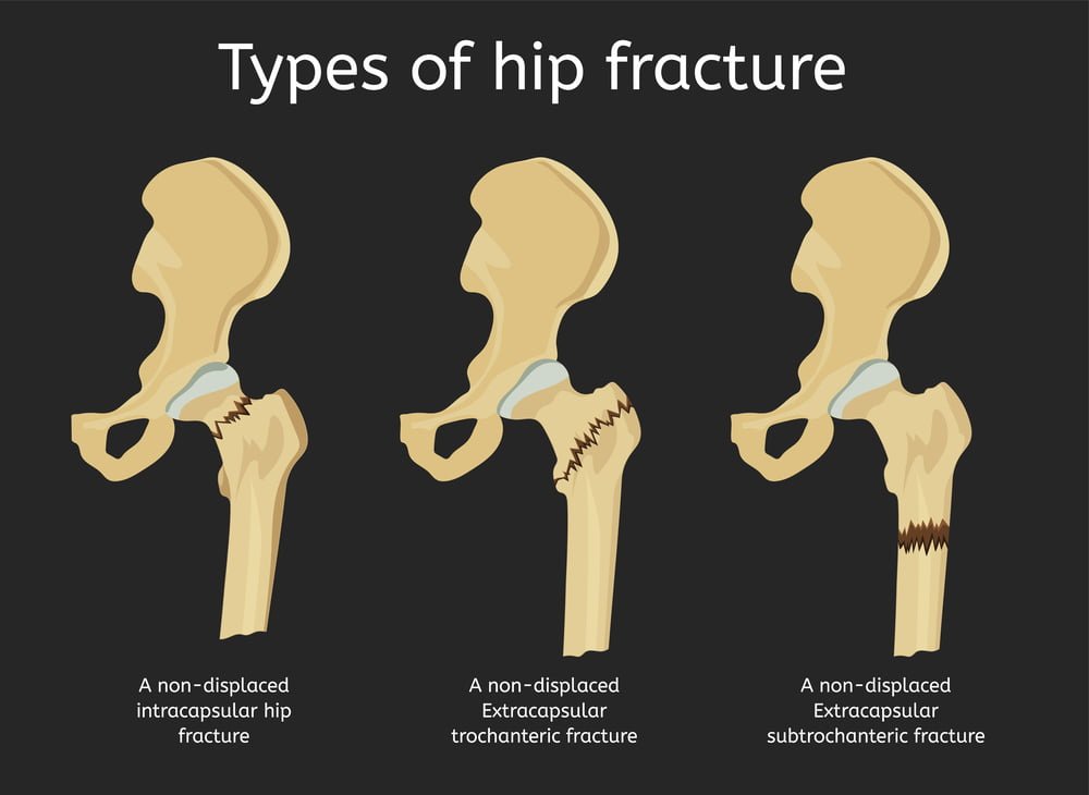 types of hip fractures 