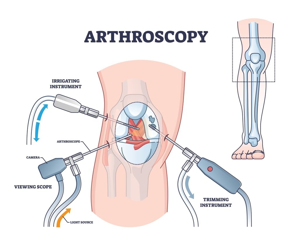 what is arthroscopy