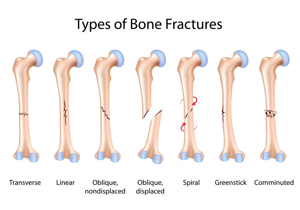 Major Types Of Bones Fracture