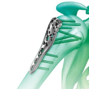 types of orthopedic implants