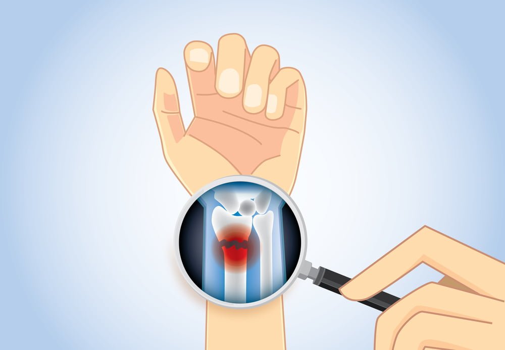 types of hand fractures