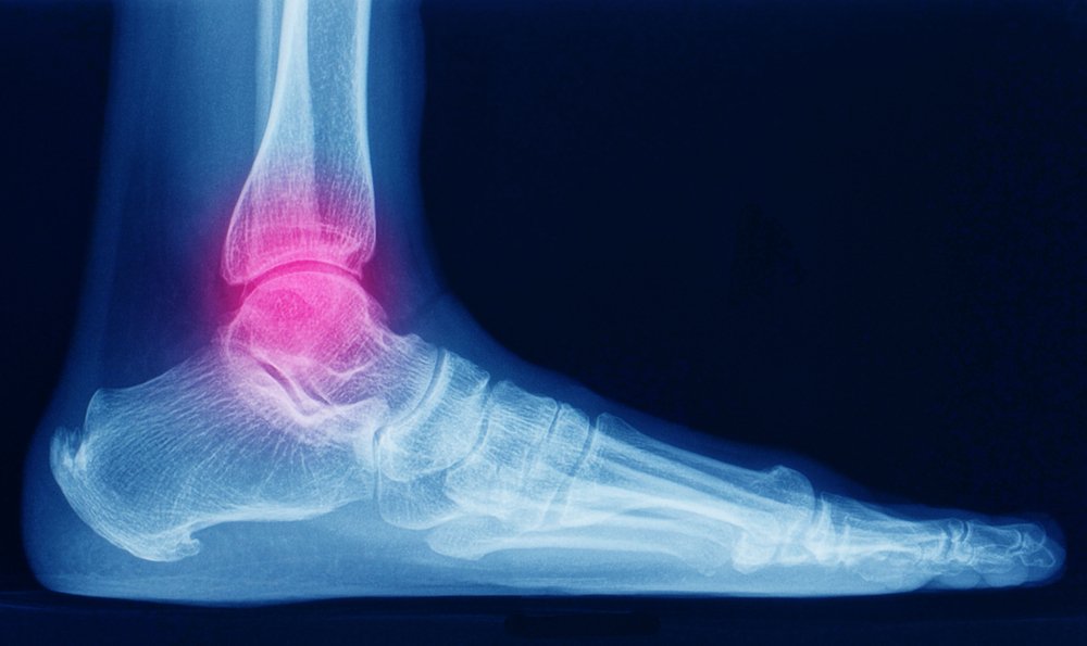 symptoms foot fracture