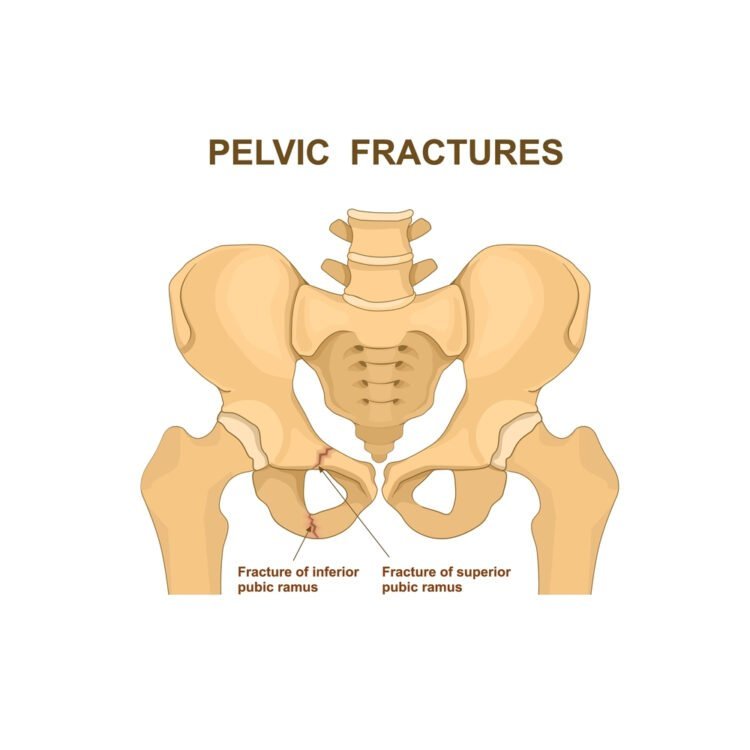 Everything You Need to Know About Pelvis Fractures and Plates - Zealmax ...