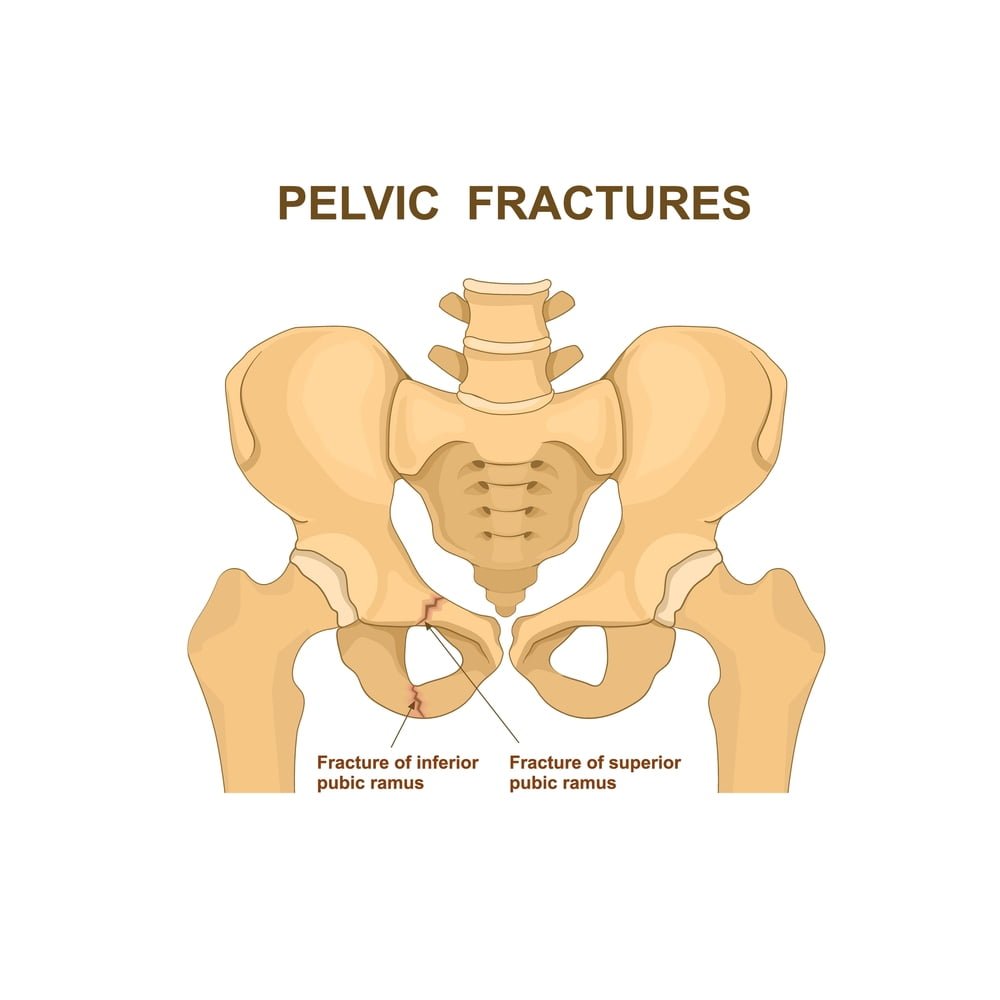 types of pelvic fracture