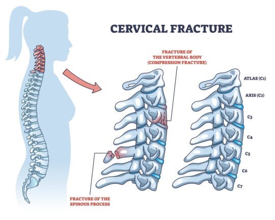 Cervical Fractures Types Symptoms Causes And Treatment Zealmax Innovations Pvt Ltd 