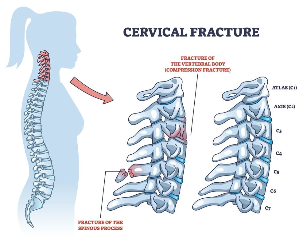 Dislocated Neck Vertebrae