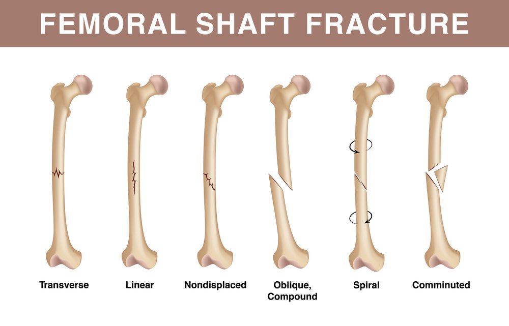 Femoral Shaft Fractures