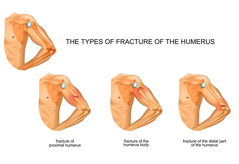 Humerus Fracture causes and treatment