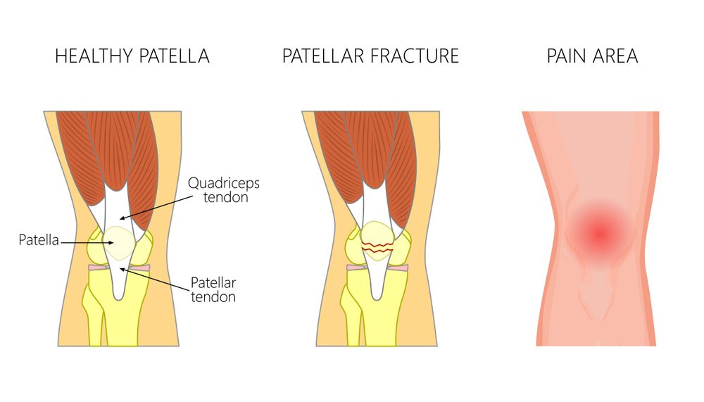 Patella Fracture