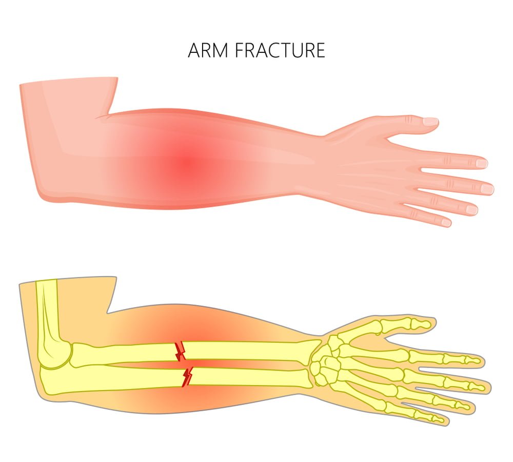 Forearm Fractures - Types, Symptoms, Causes & Treatment - Zealmax ...