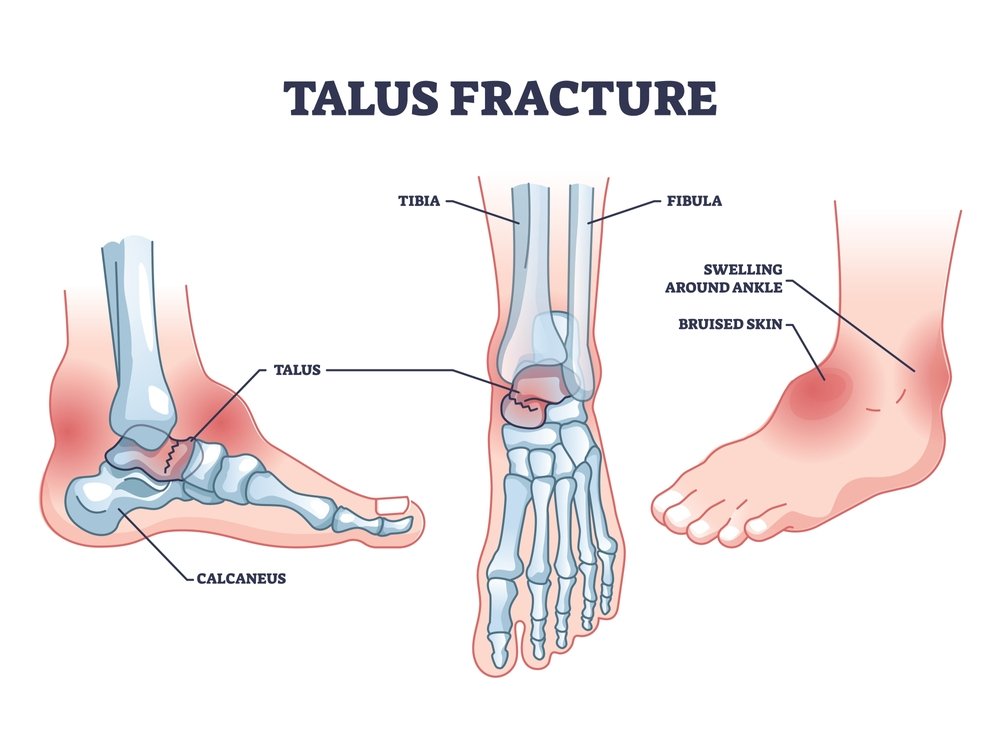 Talus Fractures