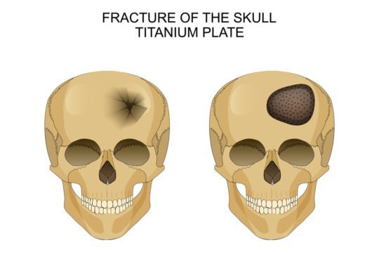 Skull Fractures Types Symptoms Causes And Treatment Zealmax Innovations Pvt Ltd 