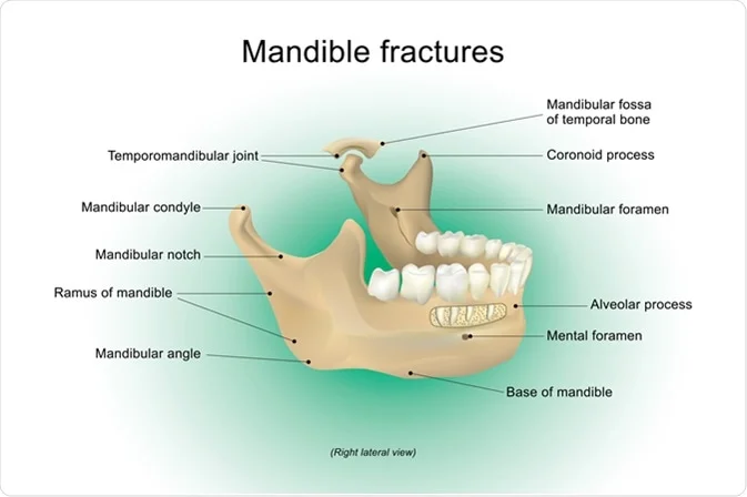 Mandibular Fracture