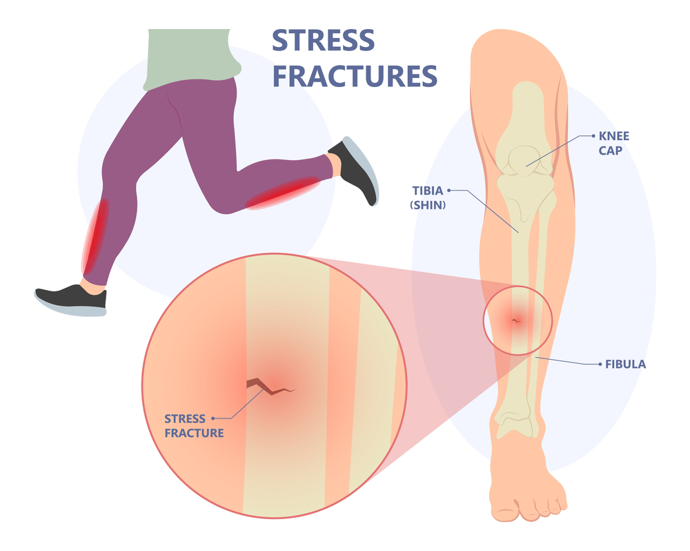 What is a Stress Fracture - Brisbane Physiotherapy