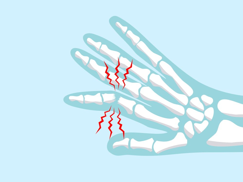 Phalanx Fracture