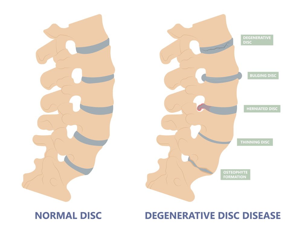 Spine Implant Manufacturer and Exporter