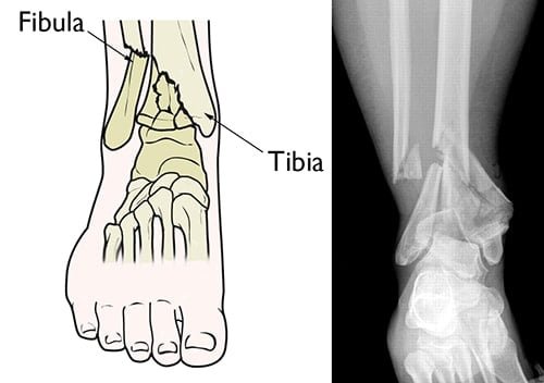 pilon fracture