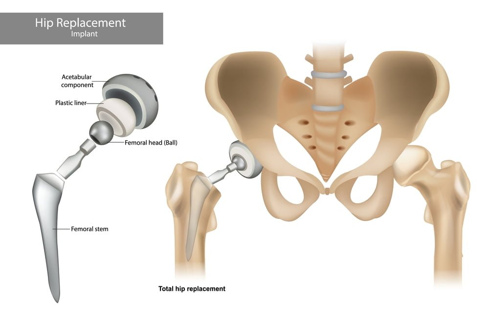 Hip Replacement Surgery