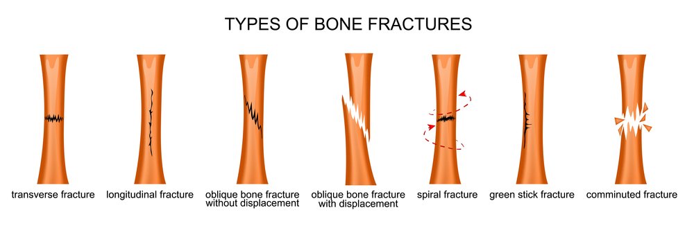 types of trauma fracture