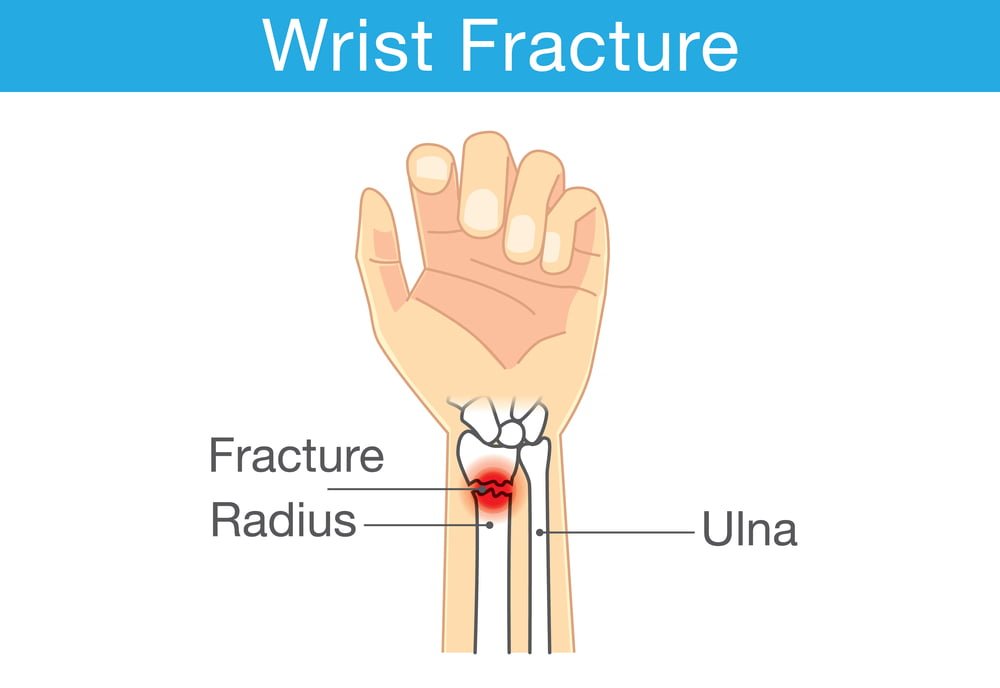 Distal Radius Fracture and Plates