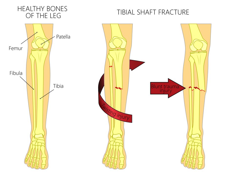 Everything You Need to Know About Tibia Fractures and Plates