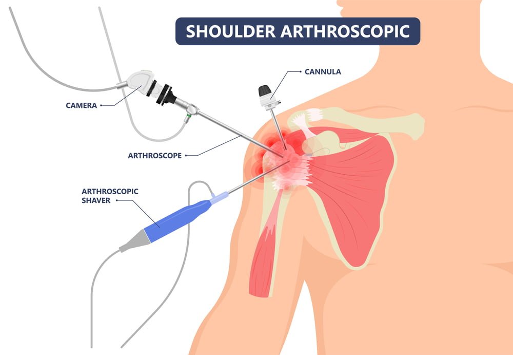 Shoulder Arthroscopy