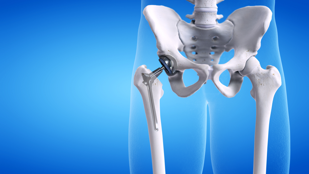 Hip Prosthesis Implants