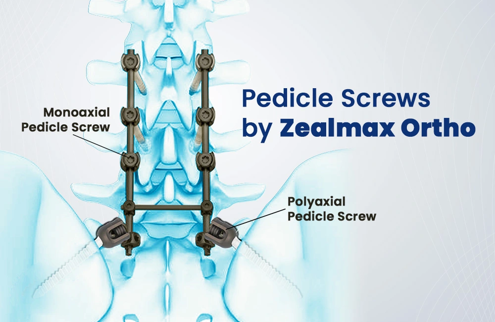 Pedicle Screws by Zealmax Ortho