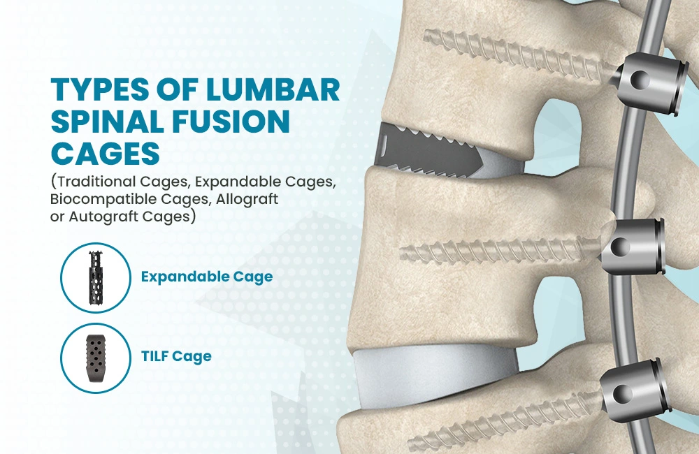 Lumbar Spinal Cages