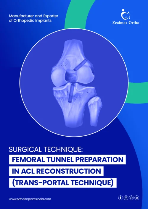 Femoral Tunnel Preparation in ACL Reconstruction (Trans-portal Technique)