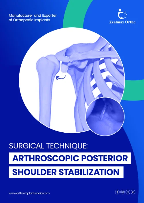 Arthroscopic Posterior Shoulder Stabilization