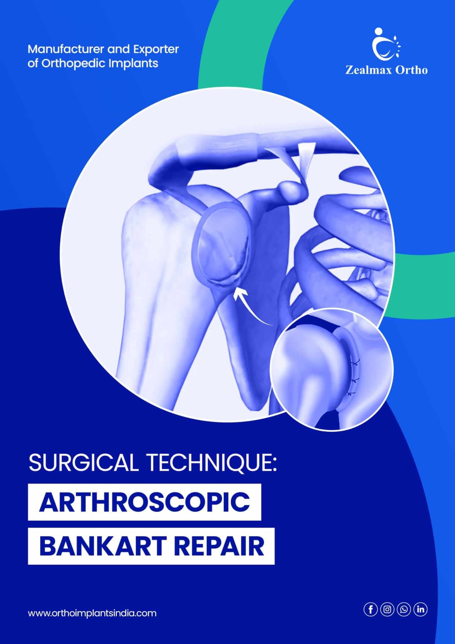 Arthroscopic Bankart Repair